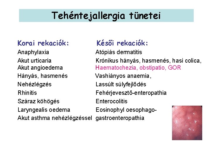 Tehéntejallergia tünetei Korai rekaciók: Késői rekaciók: Anaphylaxia Atópiás dermatitis Akut urticaria Krónikus hányás, hasmenés,