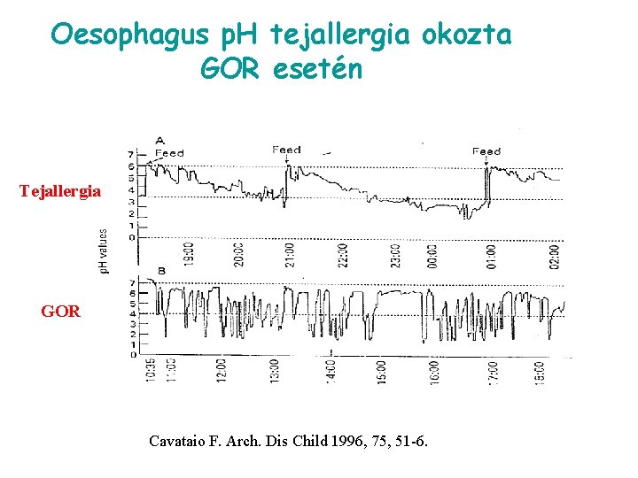 Oesophagus p. H tejallergia okozta GOR esetén Tejallergia GOR Cavataio F. Arch. Dis Child