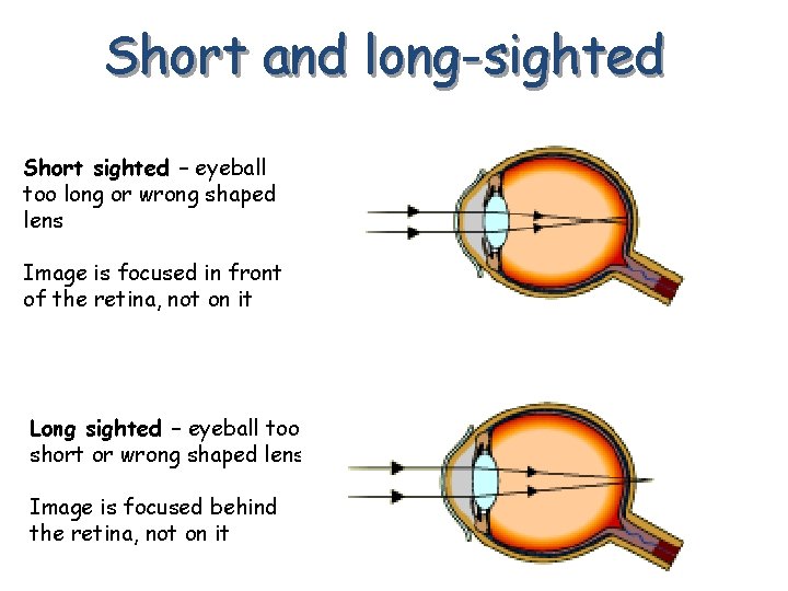 Short and long-sighted Short sighted – eyeball too long or wrong shaped lens Image