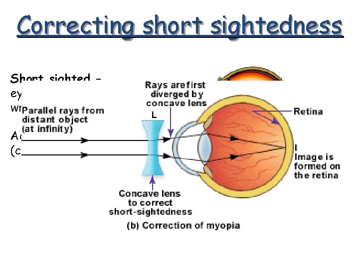 Correcting short sightedness Short sighted – eyeball too long or wrong shaped lens Add