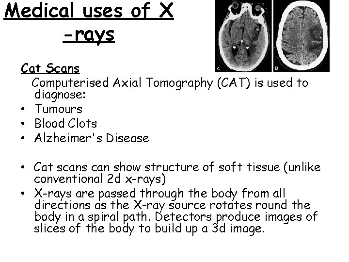 Medical uses of X -rays Cat Scans Computerised Axial Tomography (CAT) is used to