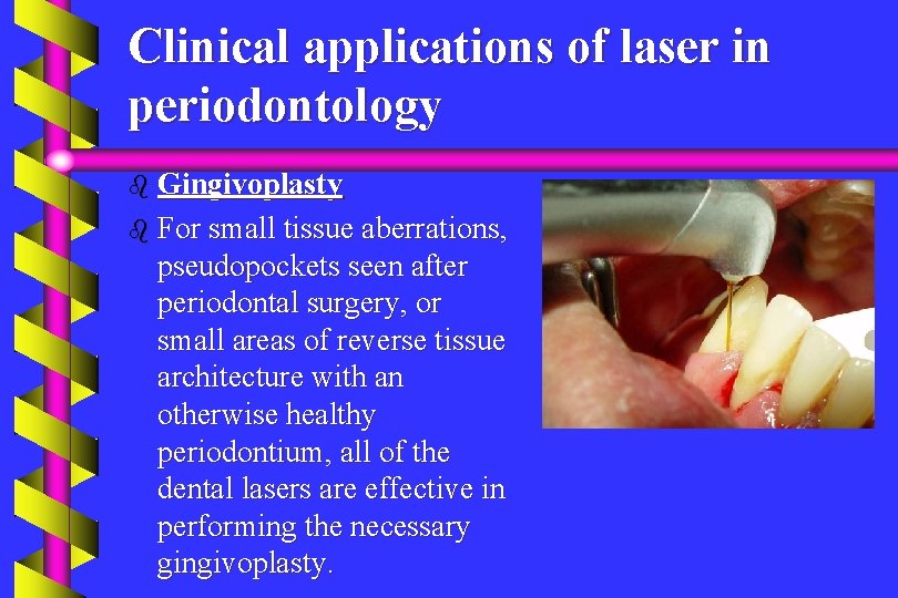 Clinical applications of laser in periodontology b Gingivoplasty b For small tissue aberrations, pseudopockets