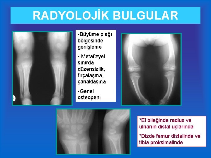 RADYOLOJİK BULGULAR • Büyüme plağı bölgesinde genişleme • Metafizyel sınırda düzensizlik, fırçalaşma, çanaklaşma •