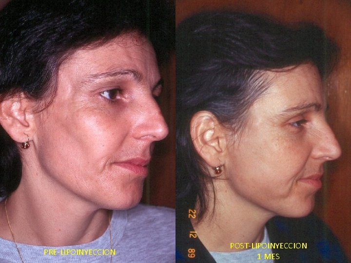 PRE-LIPOINYECCION POST-LIPOINYECCION 1 MES 