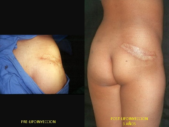 PRE-LIPOINYECCION POST-LIPOINYECCION 3 AÑOS 