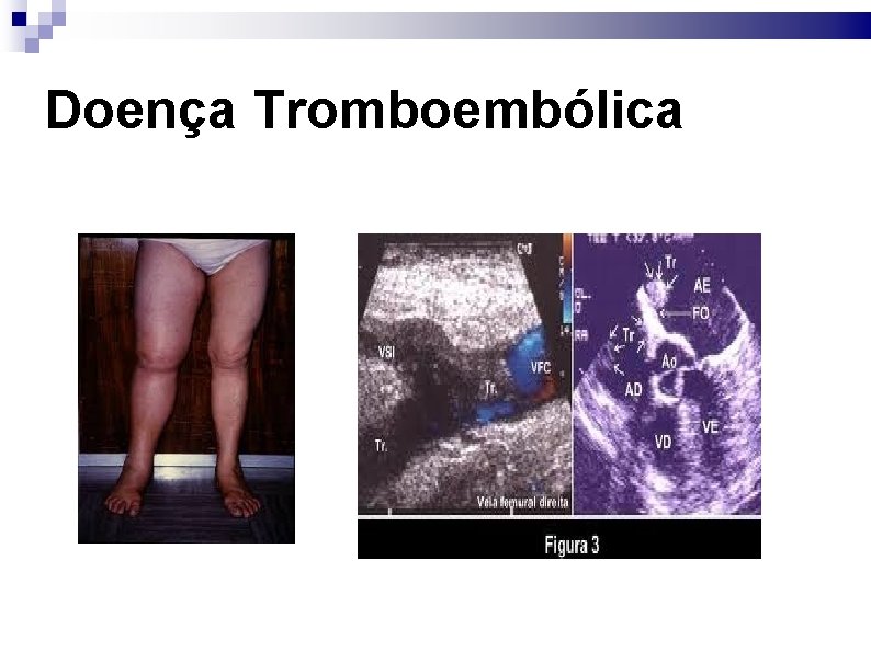 Doença Tromboembólica 