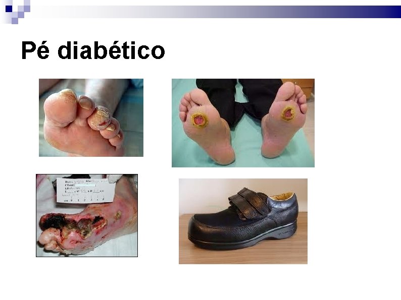 Pé diabético 