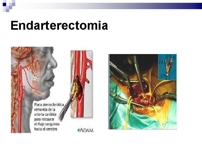Endarterectomia 
