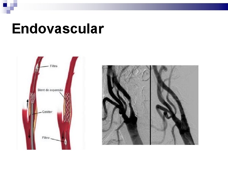 Endovascular 