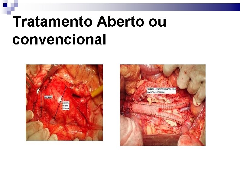 Tratamento Aberto ou convencional 