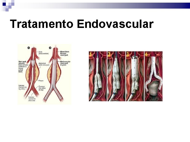 Tratamento Endovascular 