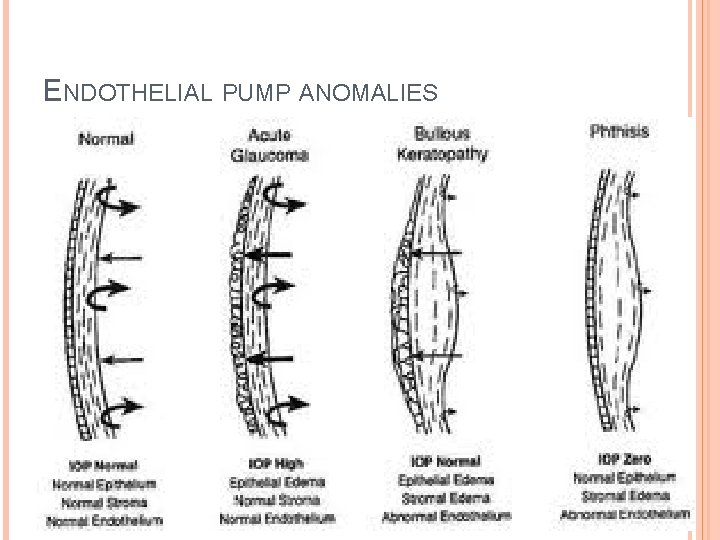 ENDOTHELIAL PUMP ANOMALIES 