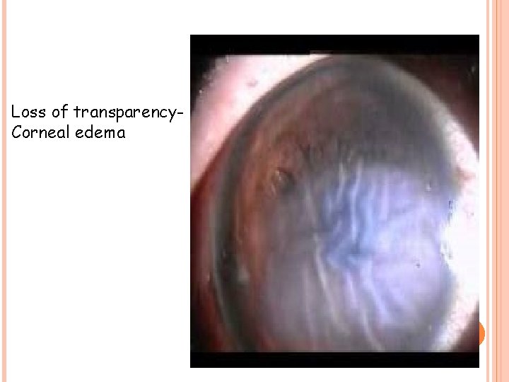 Loss of transparency. Corneal edema 