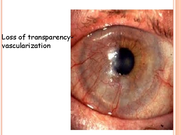 Loss of transparencyvascularization 