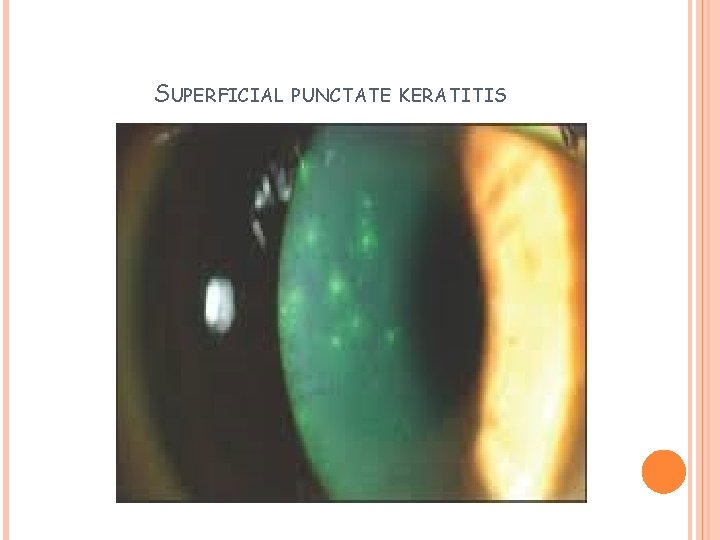 SUPERFICIAL PUNCTATE KERATITIS 