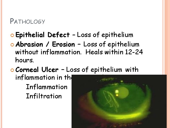 PATHOLOGY Epithelial Defect – Loss of epithelium Abrasion / Erosion – Loss of epithelium