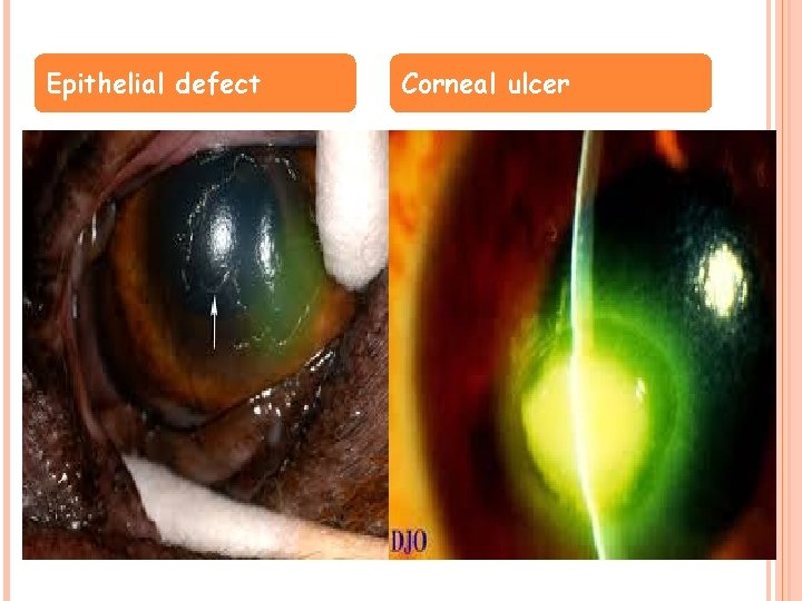 Epithelial defect Corneal ulcer 
