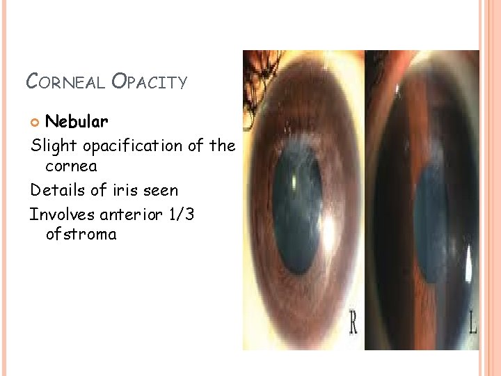 CORNEAL OPACITY Nebular Slight opacification of the cornea Details of iris seen Involves anterior