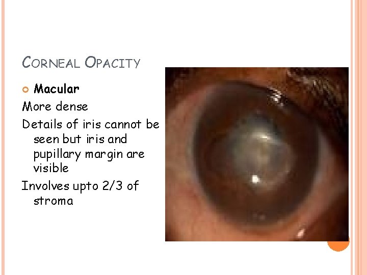 CORNEAL OPACITY Macular More dense Details of iris cannot be seen but iris and