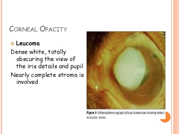 CORNEAL OPACITY Leucoma Dense white, totally obscuring the view of the iris details and