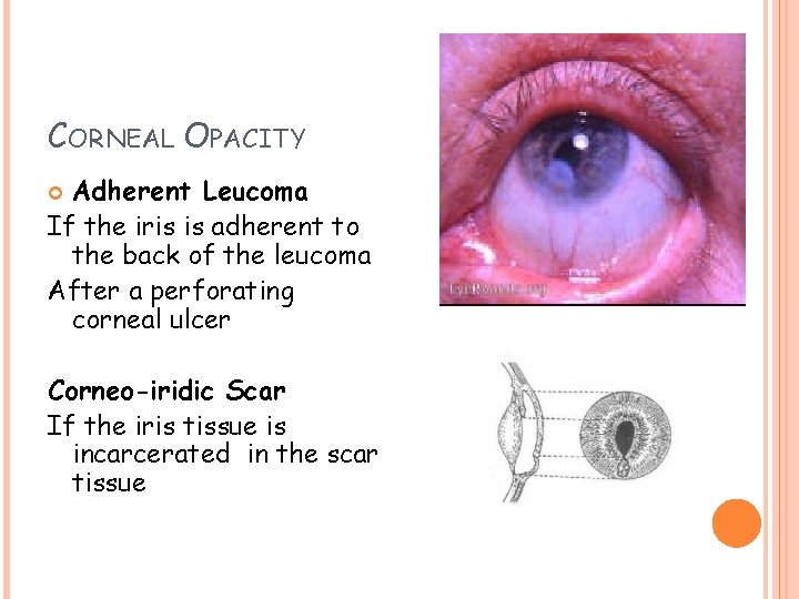 CORNEAL OPACITY Adherent Leucoma If the iris is adherent to the back of the
