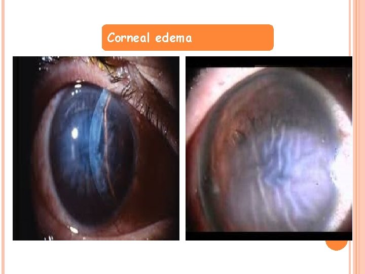 Corneal edema 