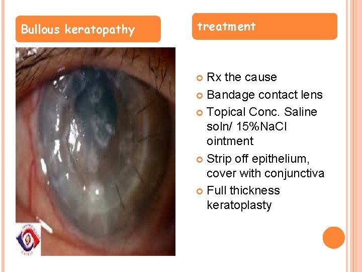 Bullous keratopathy treatment Rx the cause Bandage contact lens Topical Conc. Saline soln/ 15%Na.