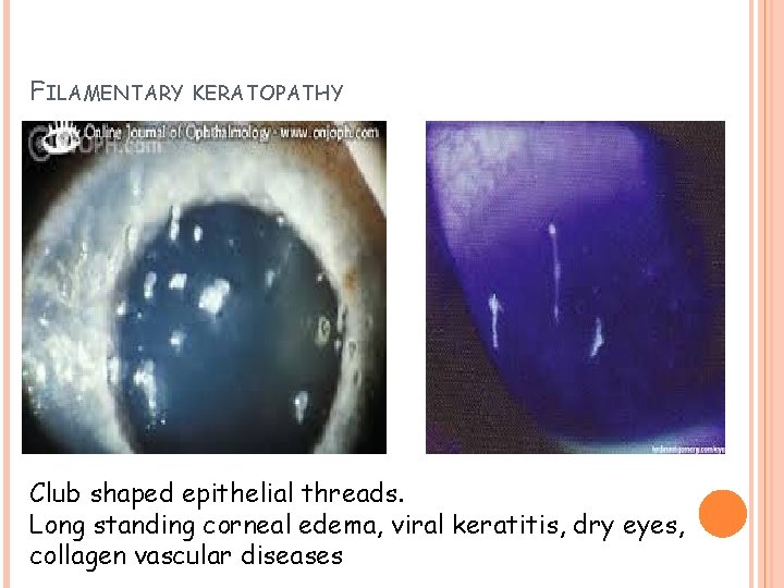 FILAMENTARY KERATOPATHY Club shaped epithelial threads. Long standing corneal edema, viral keratitis, dry eyes,