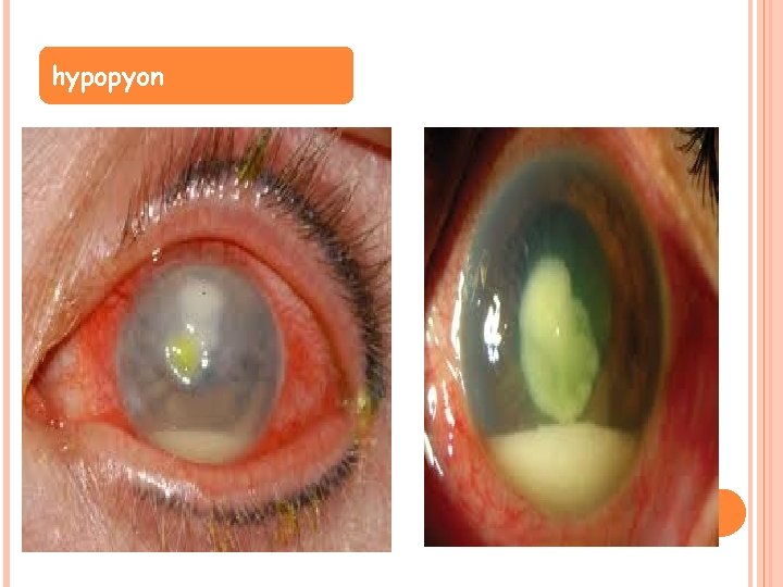 hypopyon 