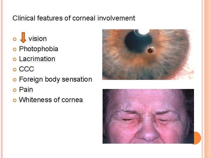 Clinical features of corneal involvement vision Photophobia Lacrimation CCC Foreign body sensation Pain Whiteness