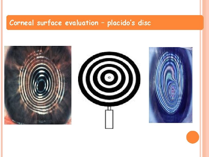 Corneal surface evaluation – placido’s disc 