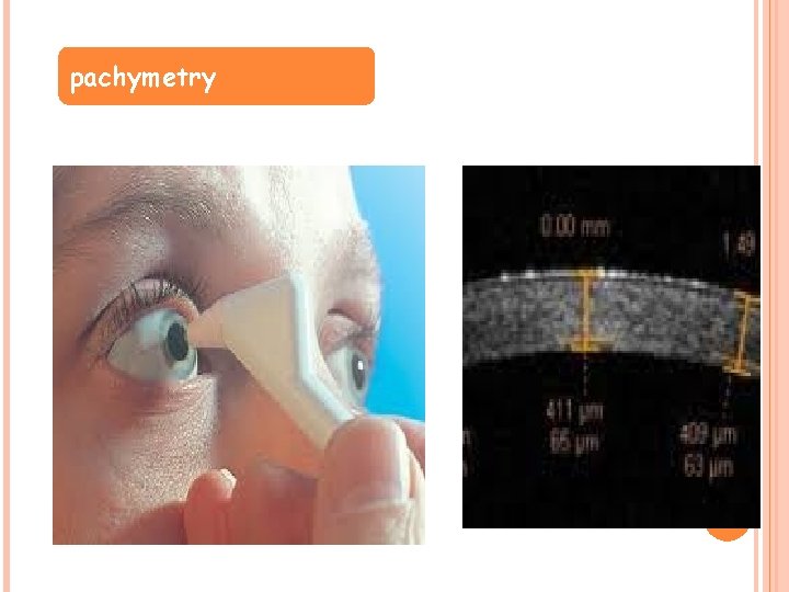 pachymetry 