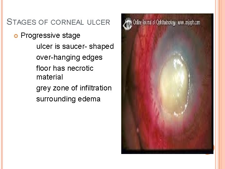 STAGES OF CORNEAL ULCER Progressive stage ulcer is saucer- shaped over-hanging edges floor has