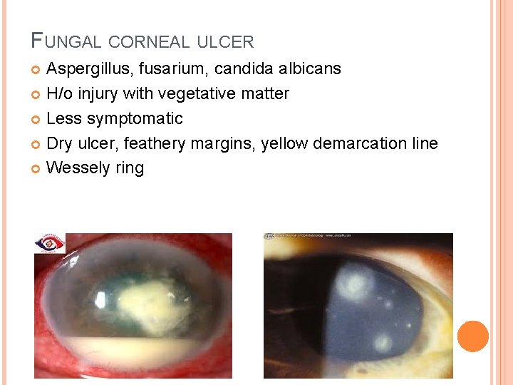 FUNGAL CORNEAL ULCER Aspergillus, fusarium, candida albicans H/o injury with vegetative matter Less symptomatic