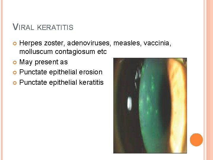 VIRAL KERATITIS Herpes zoster, adenoviruses, measles, vaccinia, molluscum contagiosum etc May present as Punctate