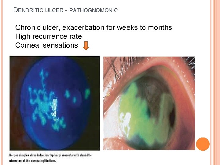 DENDRITIC ULCER - PATHOGNOMONIC Chronic ulcer, exacerbation for weeks to months High recurrence rate