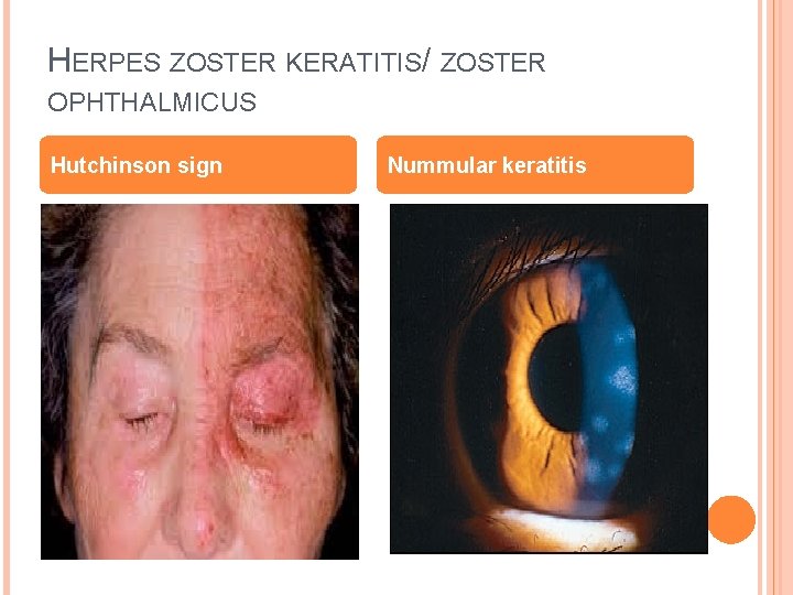 HERPES ZOSTER KERATITIS/ ZOSTER OPHTHALMICUS Hutchinson sign Nummular keratitis 