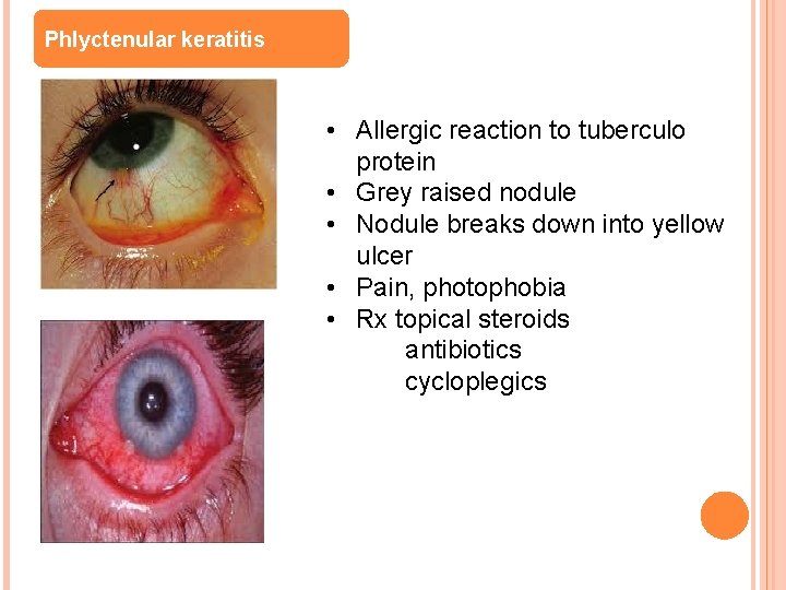 Phlyctenular keratitis • Allergic reaction to tuberculo protein • Grey raised nodule • Nodule