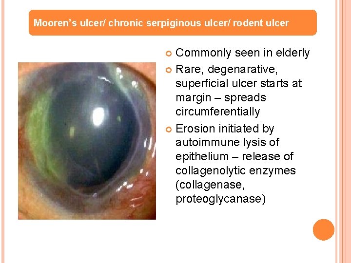 Mooren’s ulcer/ chronic serpiginous ulcer/ rodent ulcer Commonly seen in elderly Rare, degenarative, superficial