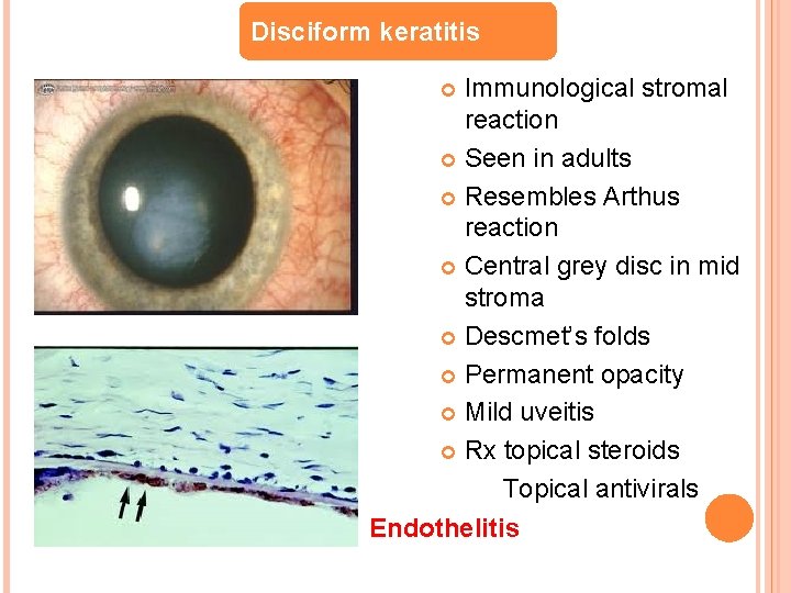 Disciform keratitis Immunological stromal reaction Seen in adults Resembles Arthus reaction Central grey disc