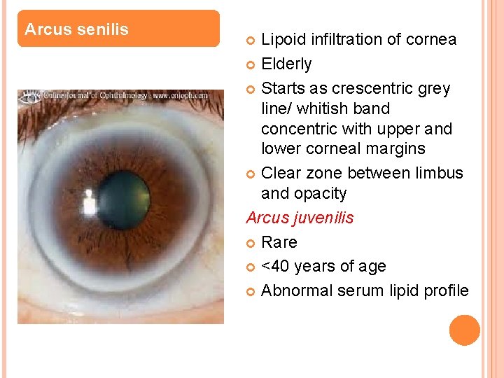 Arcus senilis Lipoid infiltration of cornea Elderly Starts as crescentric grey line/ whitish band