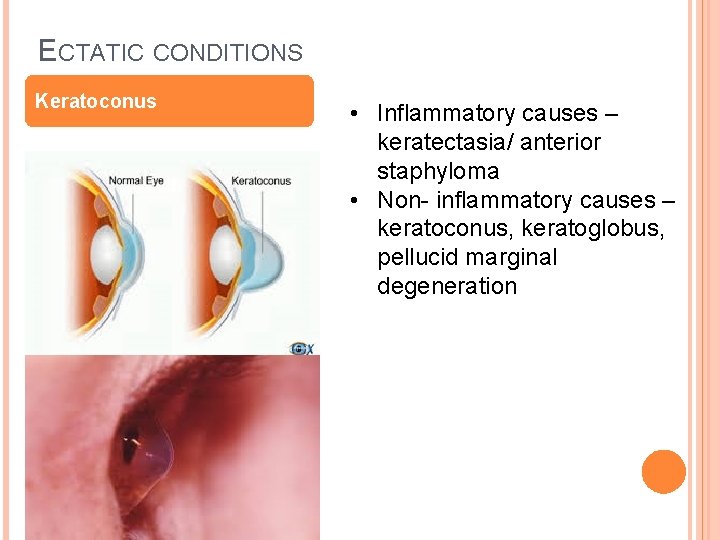 ECTATIC CONDITIONS Keratoconus • Inflammatory causes – keratectasia/ anterior staphyloma • Non- inflammatory causes