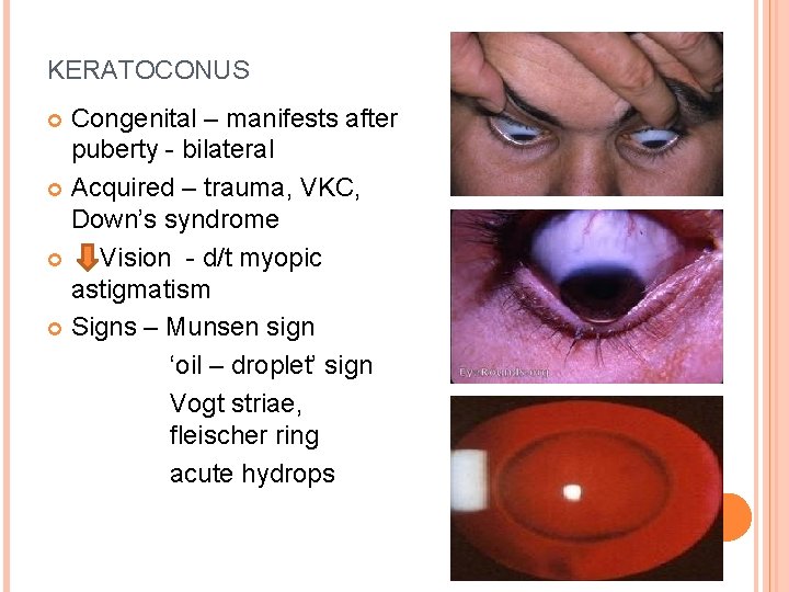 KERATOCONUS Congenital – manifests after puberty - bilateral Acquired – trauma, VKC, Down’s syndrome