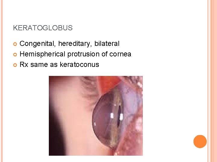 KERATOGLOBUS Congenital, hereditary, bilateral Hemispherical protrusion of cornea Rx same as keratoconus 