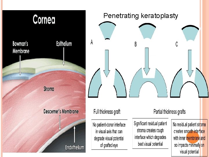 Penetrating keratoplasty 