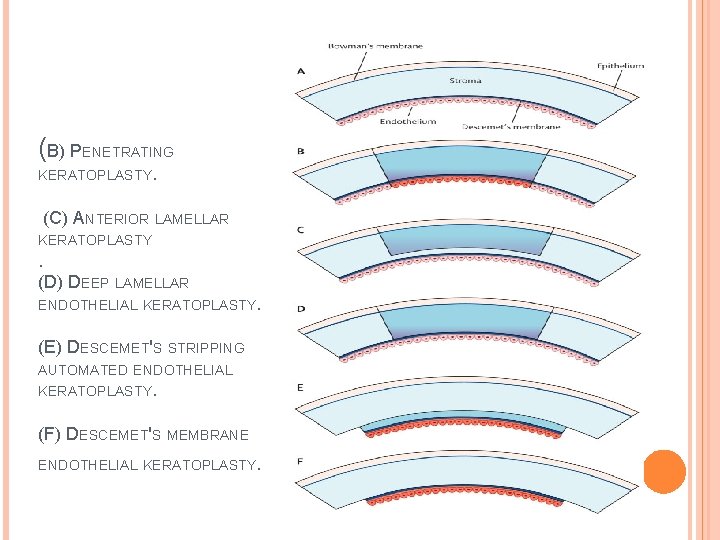 (B) PENETRATING KERATOPLASTY. (C) ANTERIOR LAMELLAR KERATOPLASTY . (D) DEEP LAMELLAR ENDOTHELIAL KERATOPLASTY. (E)