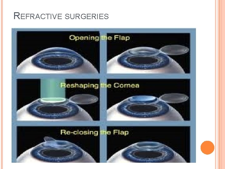 REFRACTIVE SURGERIES 