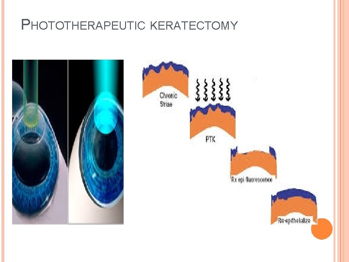 PHOTOTHERAPEUTIC KERATECTOMY 