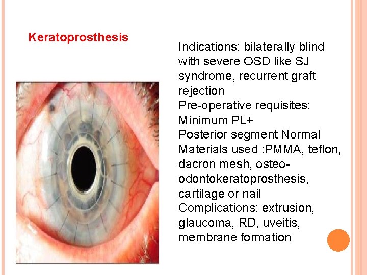 Keratoprosthesis Indications: bilaterally blind with severe OSD like SJ syndrome, recurrent graft rejection Pre-operative