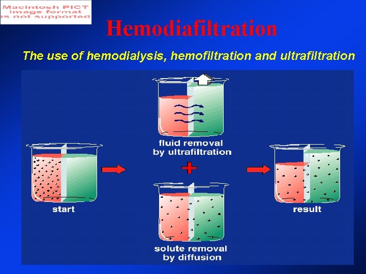 Hemodiafiltration The use of hemodialysis, hemofiltration and ultrafiltration Hemodiafiltration The use of hemodialysis, hemofiltration and ultrafiltration